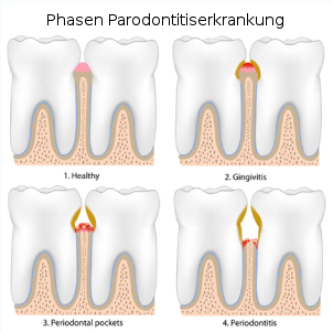 parodontose